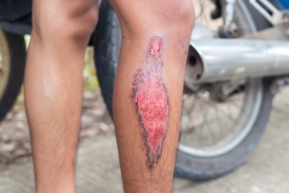 Suffering Road Rash in a Motorcycle Accident